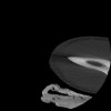 SPORK, NICO - 22.03.1976 - 02.08.2022 - CT obere Extremität - 17:51:17